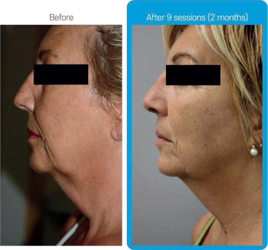 Rexonage3 clinical result