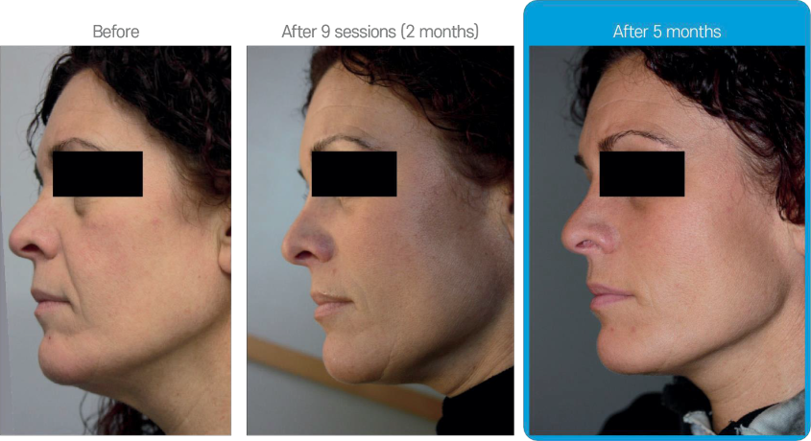 Rexonage3 clinical result