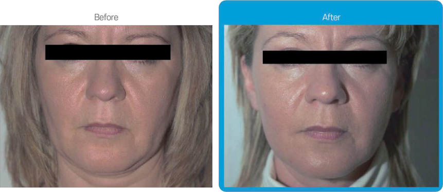 Rexonage3 clinical result