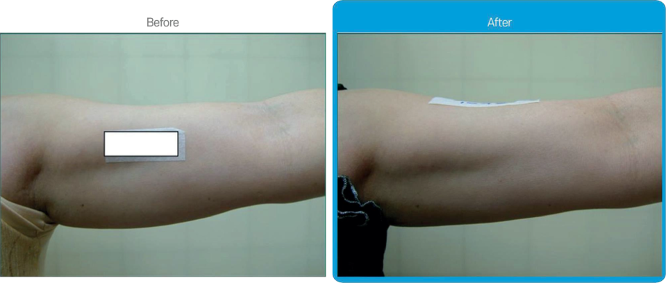 Rexonage3 clinical result